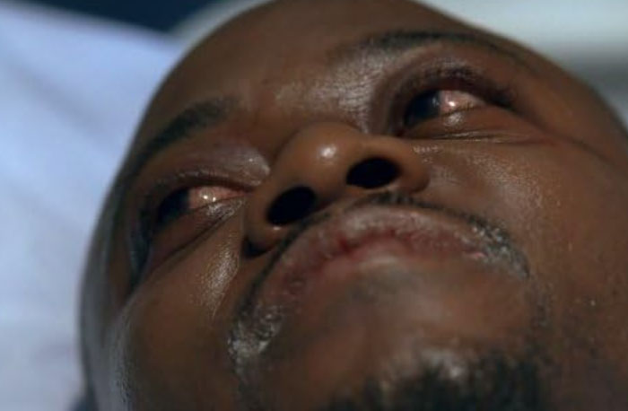 Close-up of a man with bloodshot eyes and facial injuries, illustrating medical diagnoses accuracy from House M.D.