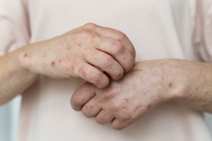 Person scratching hands covered in red rash and sores, showing nasty effects from exes that shocked and grossed out partners