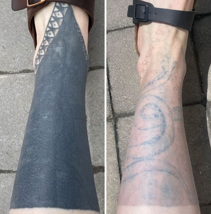 Before and after photos showing tattoo mistakes fading and skin healing after removal treatment on a person's lower leg.