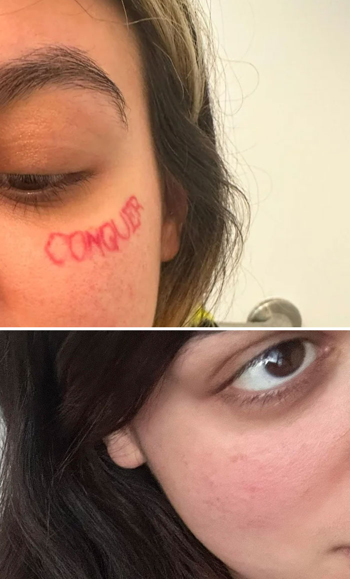Close-up before and after photos showing removal of a red face tattoo, highlighting tattoo mistakes and correction.