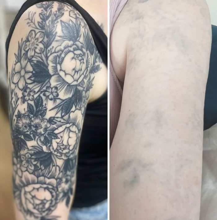 Before and after tattoo removal showing faded ink and improvement in skin appearance on the upper arm.
