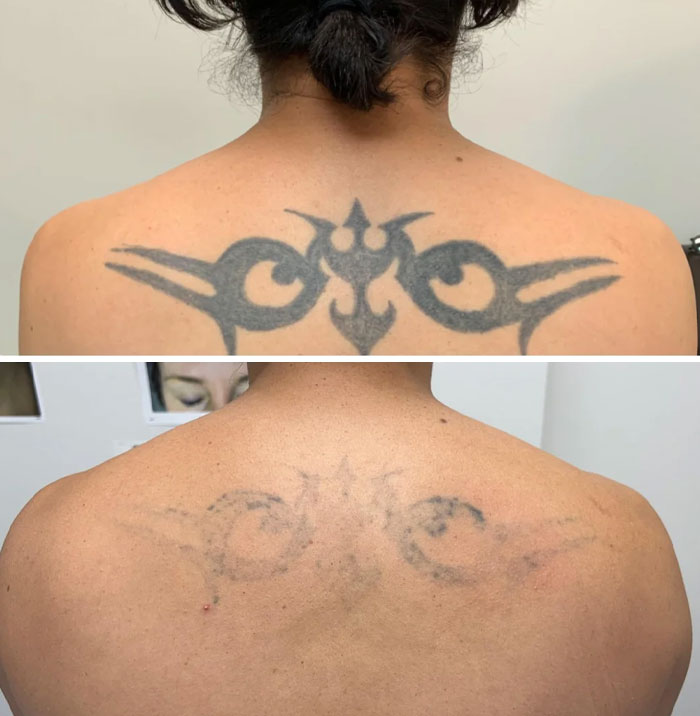 Fading tribal tattoo on upper back showing before and after tattoo mistake correction results.