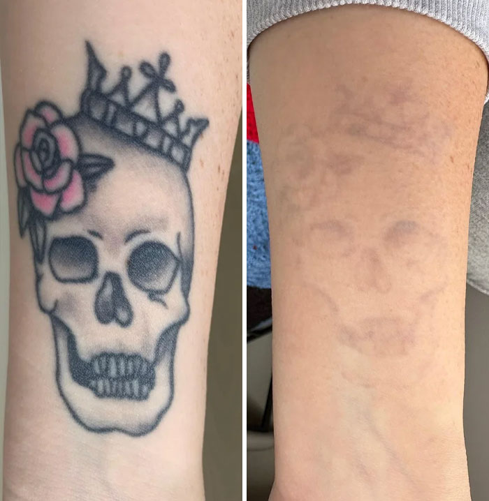 Faded tattoo removal showing before and after photos of a skull with a crown and a rose on forearm skin.