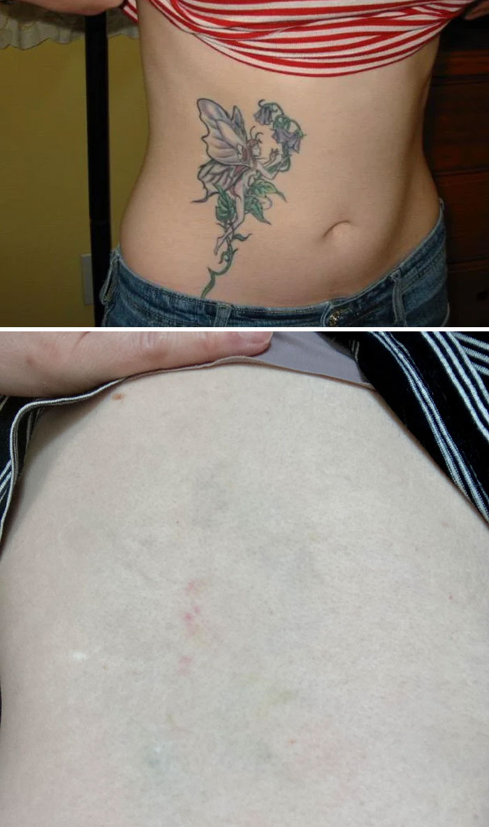 Before and after photos showing tattoo mistakes removed from skin, highlighting advances in tattoo mistake correction.