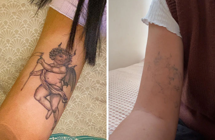 Before and after photos of tattoo mistakes showing successful tattoo cover-up and removal results on the arm.