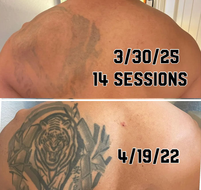 Faded tattoo on upper back after 14 removal sessions showing tattoo mistake correction progress.