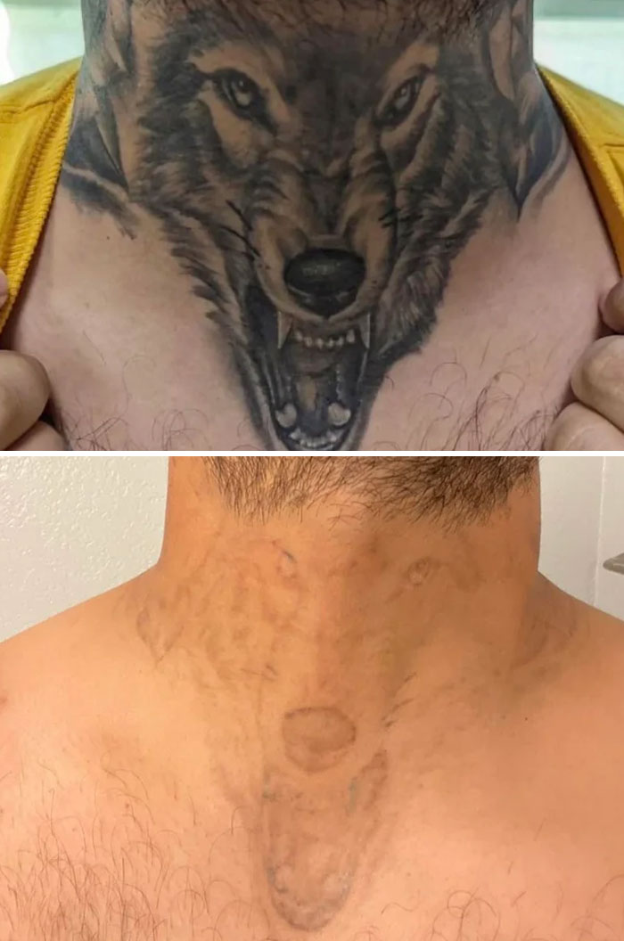 Before and after photos showing tattoo mistakes fading on a man's neck with a wolf tattoo removal process.