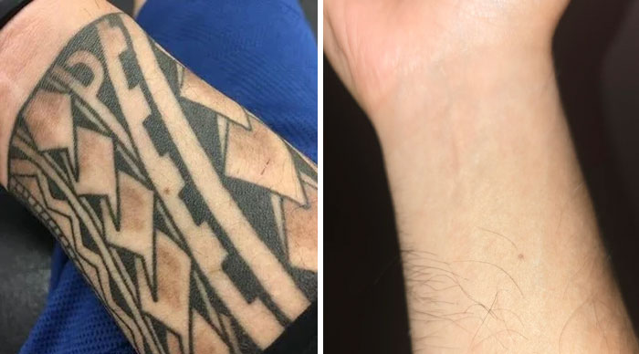 Before and after photos showing tattoo mistakes removed from a wrist, revealing clear skin in the after image.