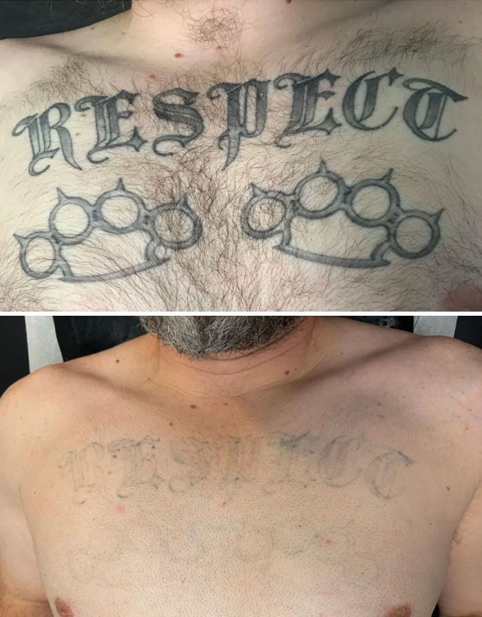 Before and after photos showing faded tattoo removal progress on a man's chest with the word respect and knuckle duster designs.