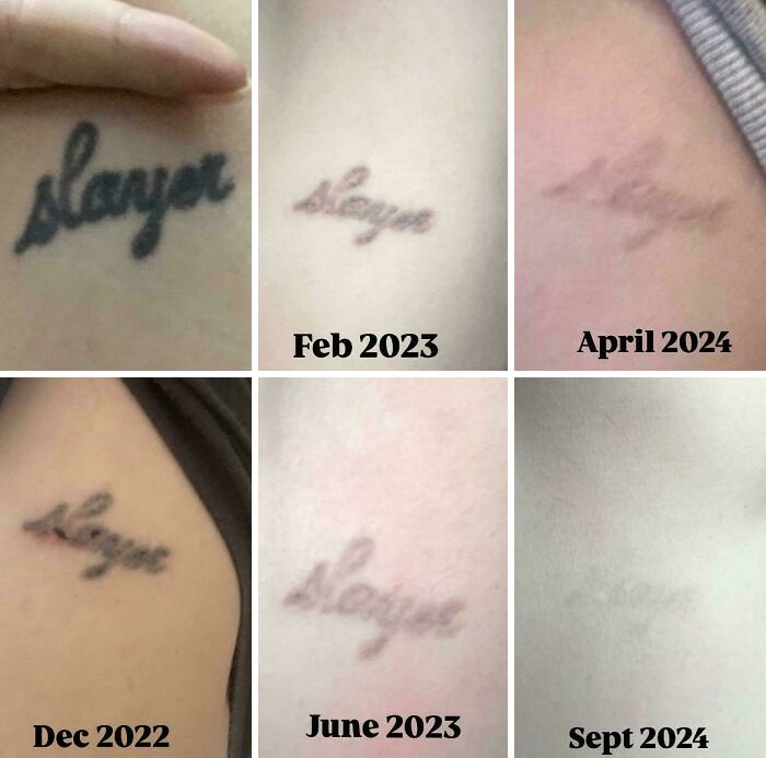 Fading tattoo removal progress shown in six photos from December 2022 to September 2024 illustrating tattoo mistakes correction.