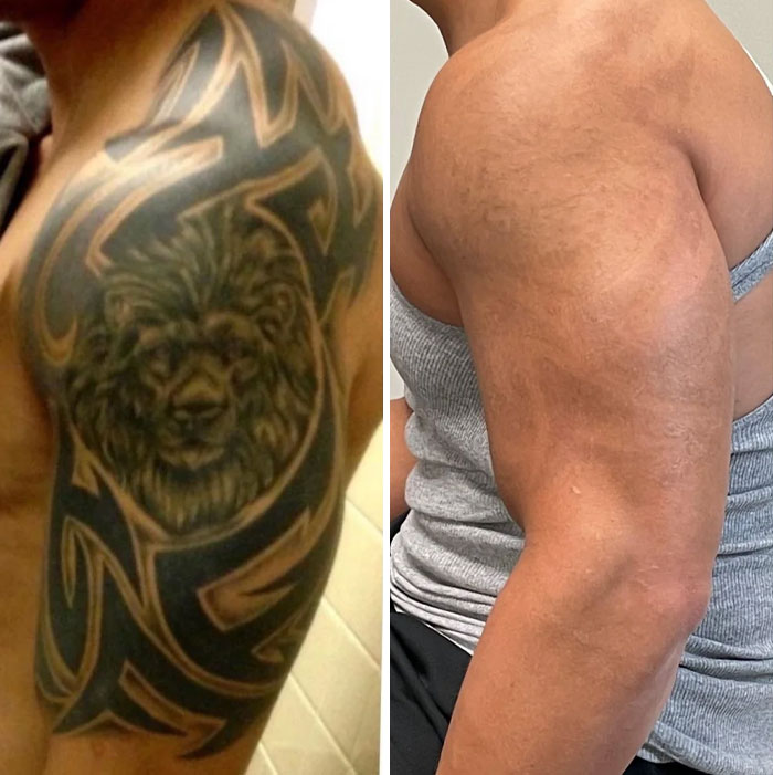 Before and after photos showing tattoo mistake removal results on a person's upper arm with clear skin improvement.