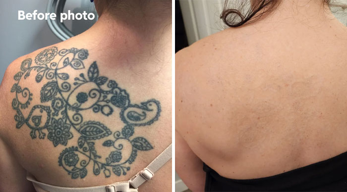 Faded floral tattoo on upper back shown in before and after photos illustrating tattoo mistake removal results.