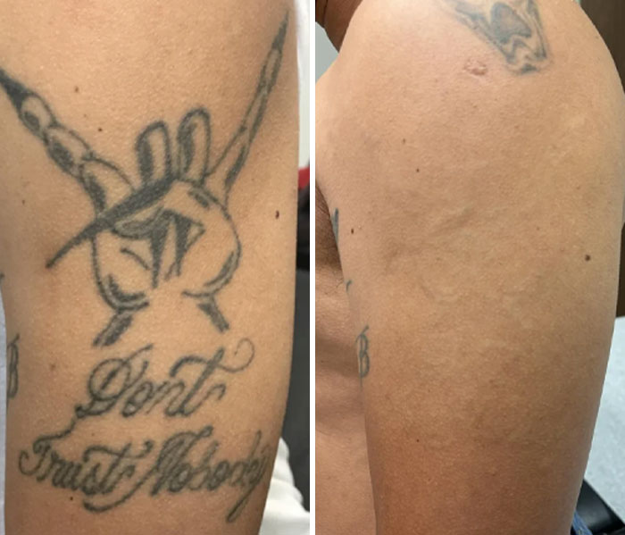 Before and after photos showing tattoo mistakes removed from a person's upper arm, highlighting tattoo correction results.