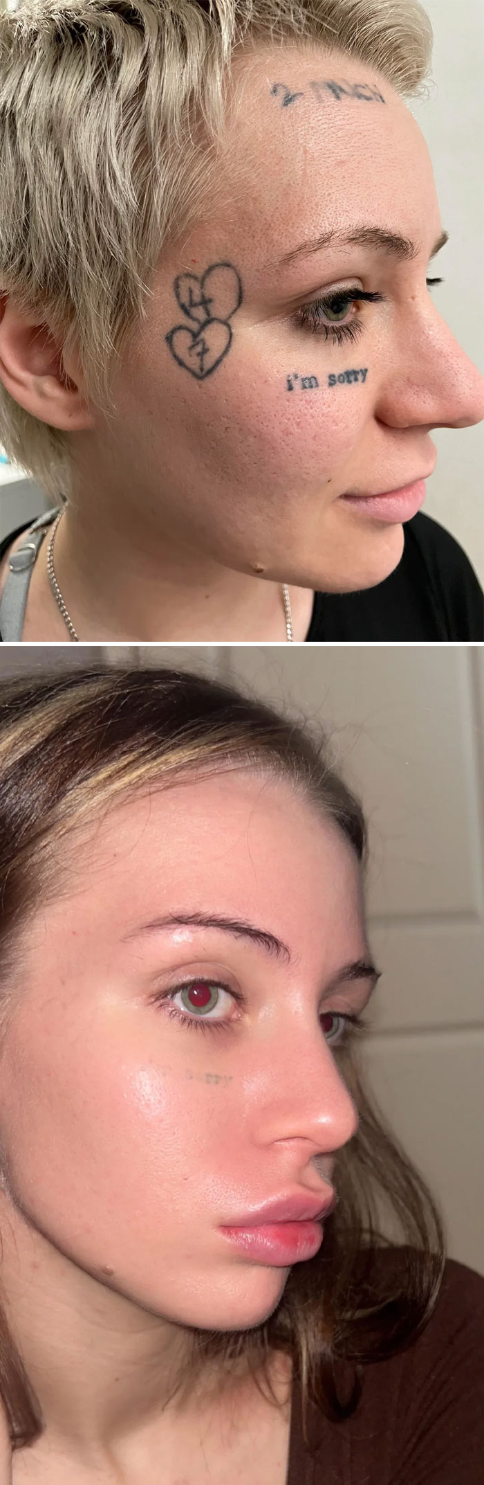 Before and after photos showing successful removal of face tattoos, illustrating tattoo mistakes aren’t permanent anymore.