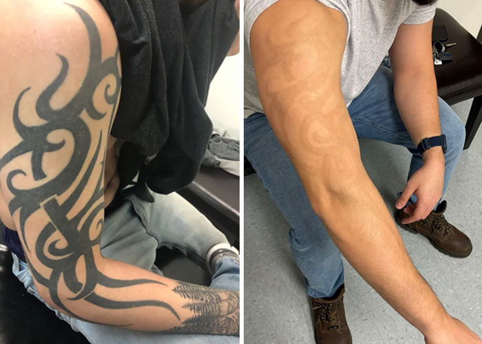 Before and after photos showing tattoo mistakes faded and removed from a man’s arm, highlighting tattoo correction progress.