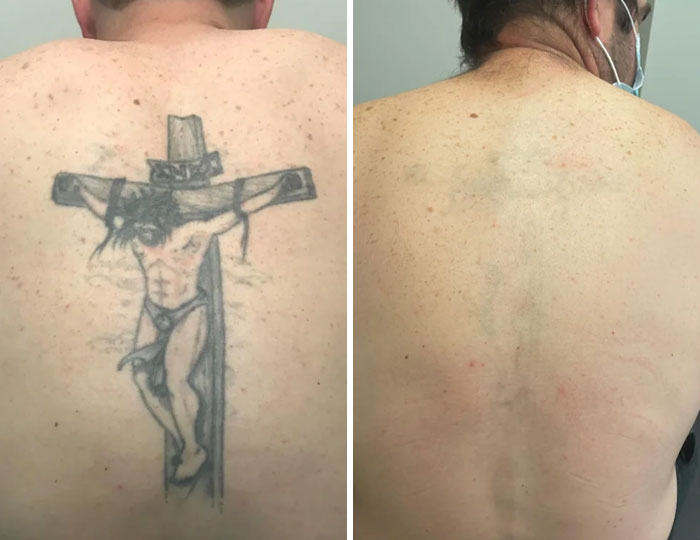 Before and after photos showing tattoo mistakes removed from a man's back using advanced tattoo removal techniques.