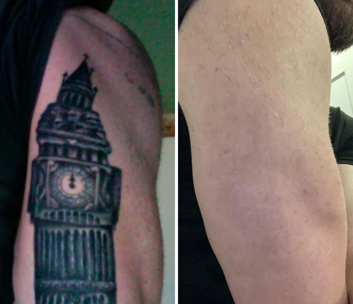 Before and after photos showing tattoo mistakes removed from upper arm, highlighting tattoo mistakes correction results.