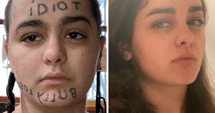 “Changed My Life!” 50 Photos Before And After Tattoo Removal