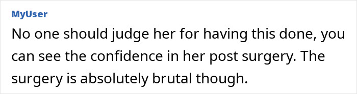31YO woman with dwarfism showing stunning transformation after teen height surgery, radiating confidence post procedure
