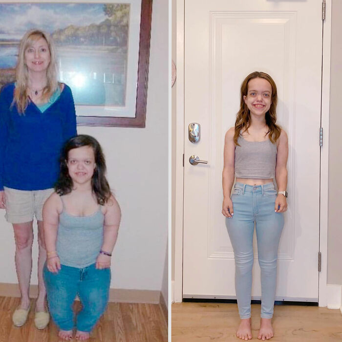 31YO woman with dwarfism before and after height surgery, showing stunning transformation and increased height standing indoors.