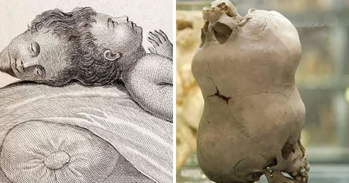 Split image showing an illustration of a two-headed child and a skull with an unusual deformity, depicting terrifying photos.