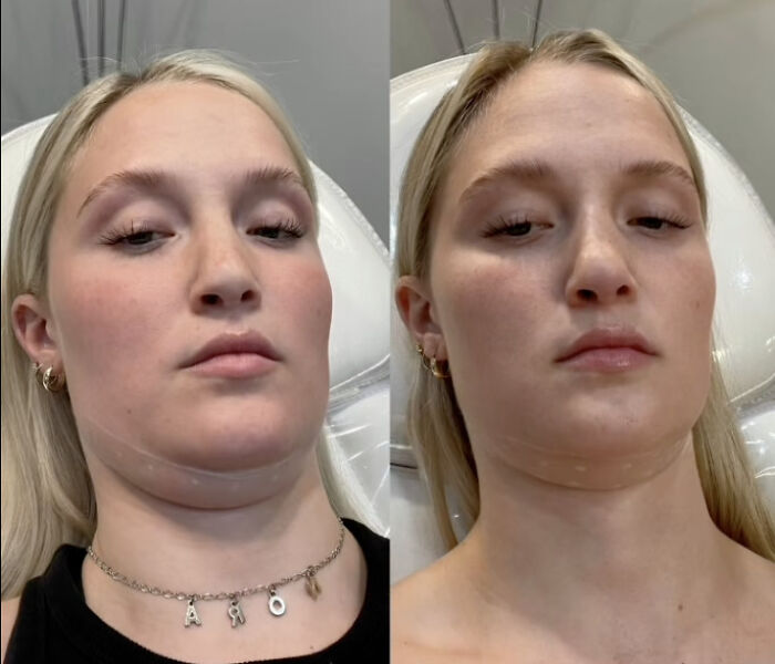 Before and after photos of a woman’s Kybella face transformation showing a slimmer jawline after recovery. Before and after photos of a woman’s Kybella face transformation showing a slimmer jawline after recovery.