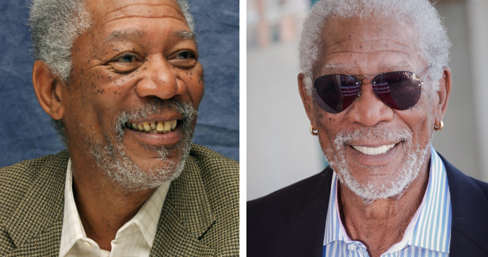 Veneers Before And After: Photos Of 15 Celebrities With The Most Dramatic Smile Makeover