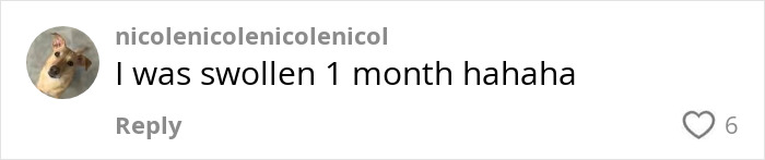 Comment on social media from user sharing experience of swelling during Kybella face transformation recovery phase. Comment on social media from user sharing experience of swelling during Kybella face transformation recovery phase.