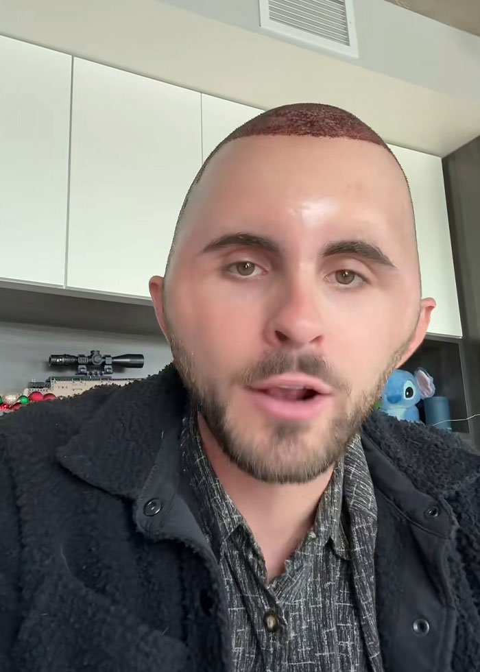 Young man showing hair transplant recovery with close shaved scalp and trimmed beard indoors at home setting