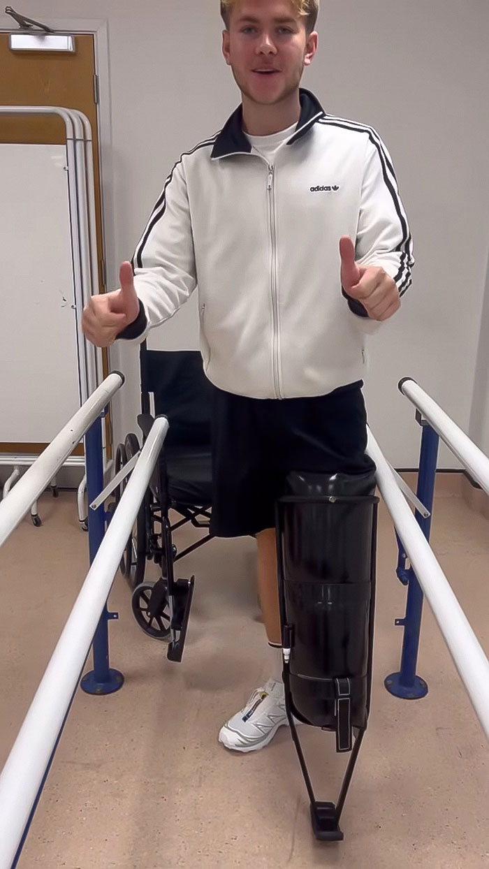 Young man with prosthetic leg giving thumbs up during rehabilitation after leg amputation following a rock concert incident.