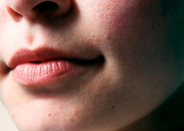 Close-up of lips and cheek showing natural skin texture, highlighting effects of cosmetic procedure regrets.