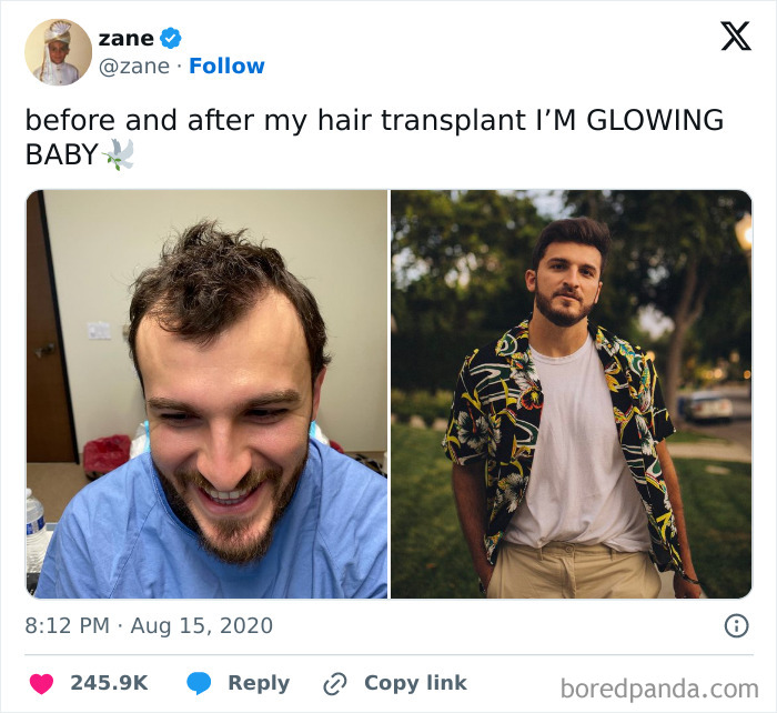 Side-by-side before and after hair transplant photos showing a man’s stunning transformation and complete reinvention.