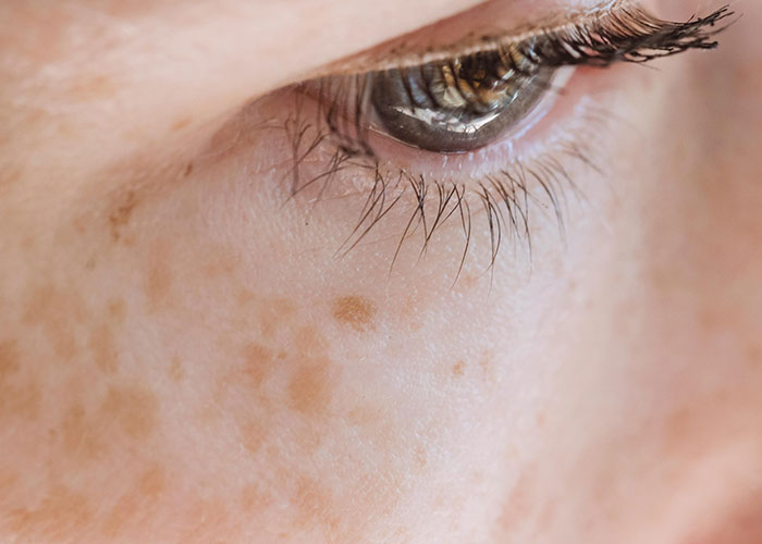 Close-up of an eye and skin showing freckles and texture, highlighting cosmetic procedure concerns and skin imperfections.