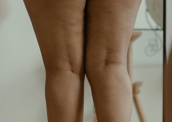 Close-up of legs showing uneven skin texture and shape after a cosmetic procedure gone wrong.