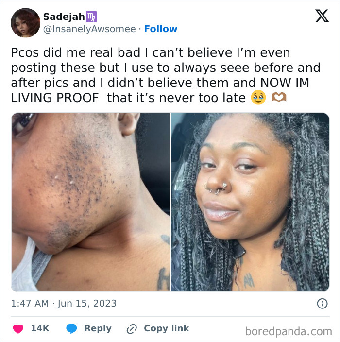 Side-by-side before and after photos showing a woman’s skin transformation proving anyone can completely reinvent themselves.