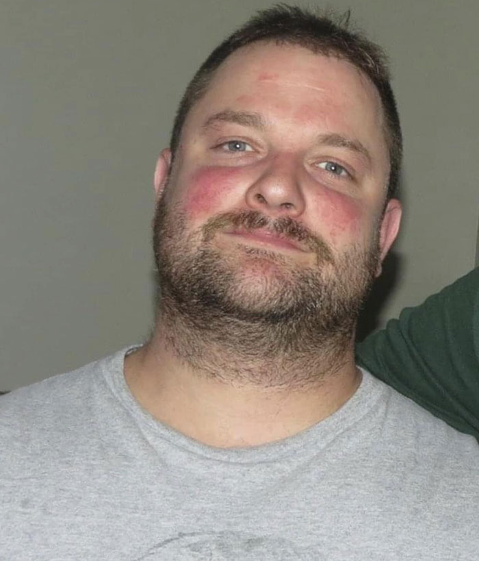 Man with beard and flushed cheeks wearing a gray shirt, related to morbidly obese patient and Instagram-famous dentist story