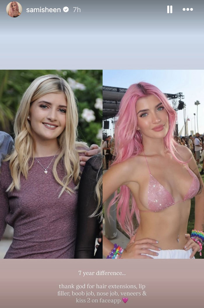 Before-and-after photos of Charlie Sheen's daughter showing her plastic surgeries including lip filler, nose job, and boob job.