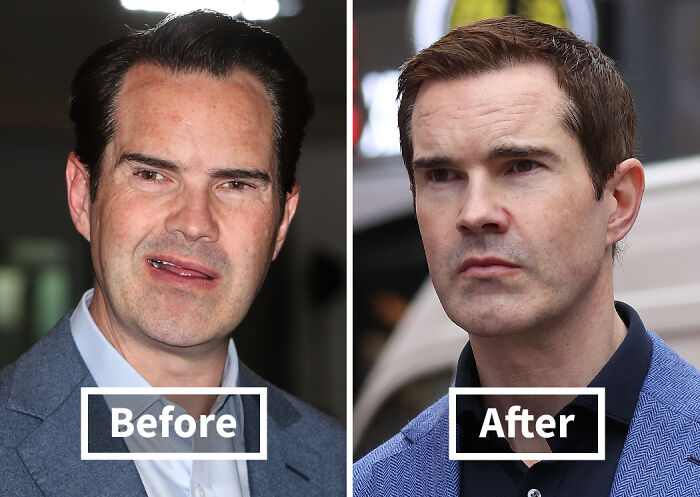Side-by-side before and after images of a man showing noticeable improvement after hair transplants.