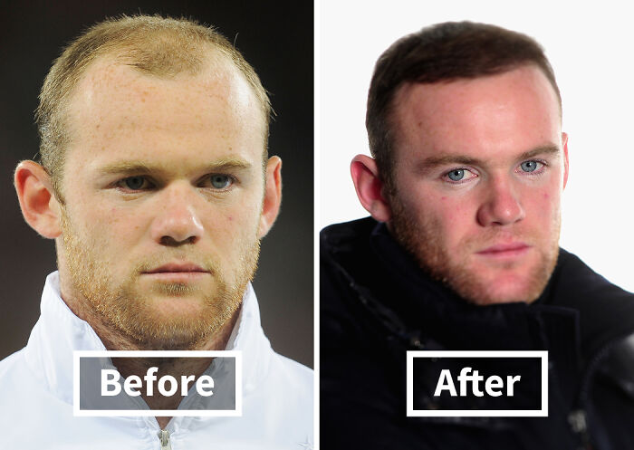 Side-by-side photos of a man showing noticeable improvement after hair transplants with fuller hair in the after image.