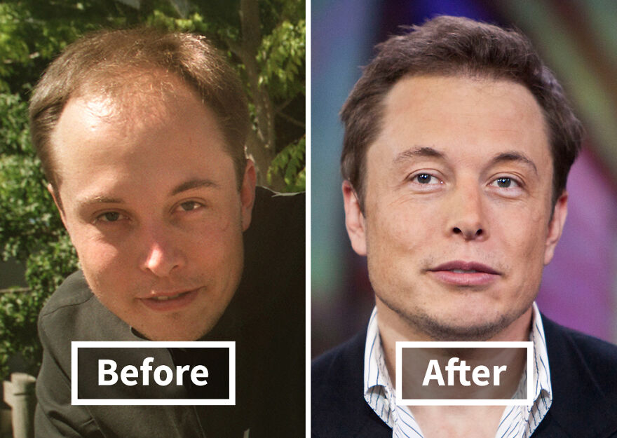 Side by side before and after photos of a Elon Musk showing results of hair transplant transformation.