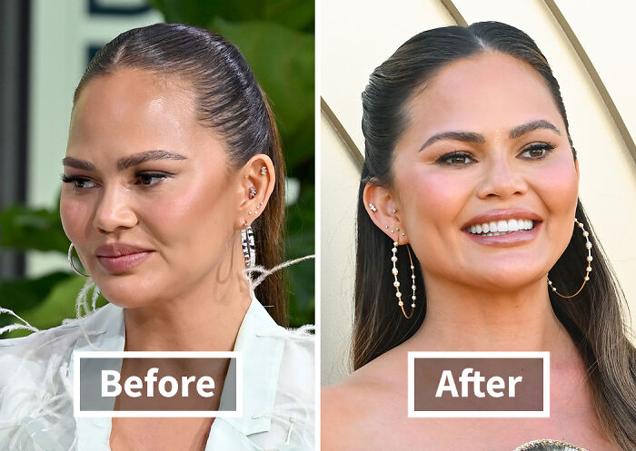 Side by side before and after photos of a woman showing results of hair transplants on a celebrity.