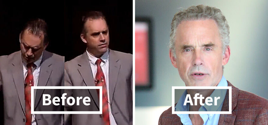 Before and after photos showing a Jordan Peterson hair transplant transformation with a dramatic and unrecognizable change.