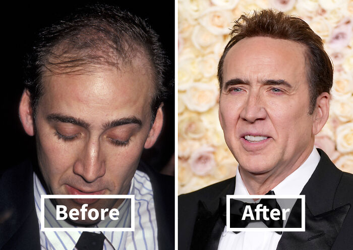 Actor showing noticeable improvement after hair transplant in before and after comparison for celebrities hair transplants.
