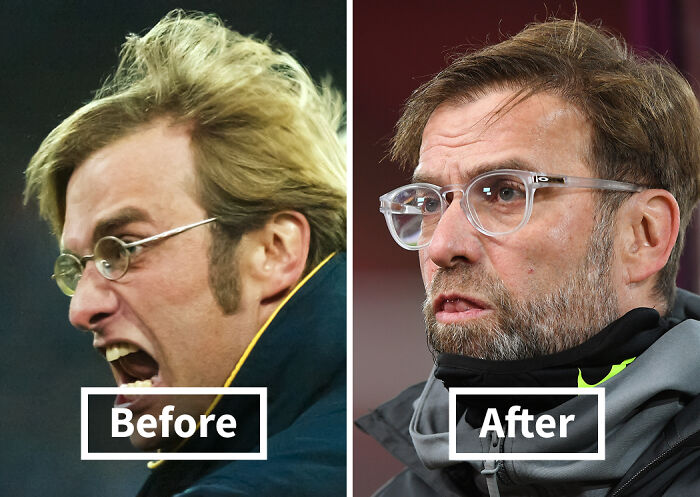 Side-by-side before and after photos of a man showing results of celebrity hair transplants improvement.