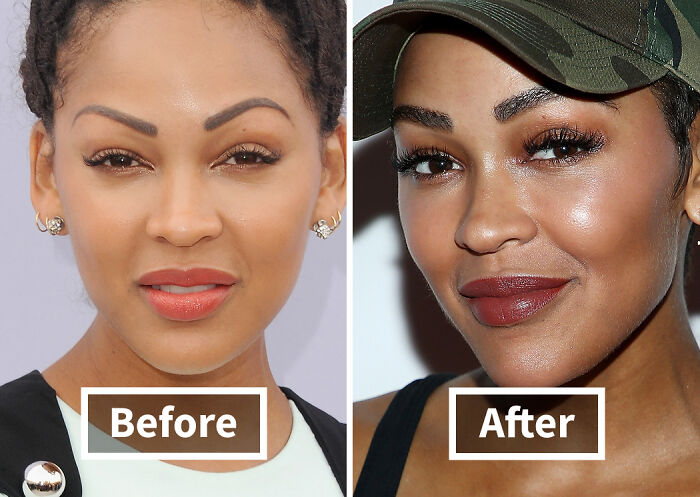 Before and after images of a woman showing noticeable improvement after hair transplant among celebrities.