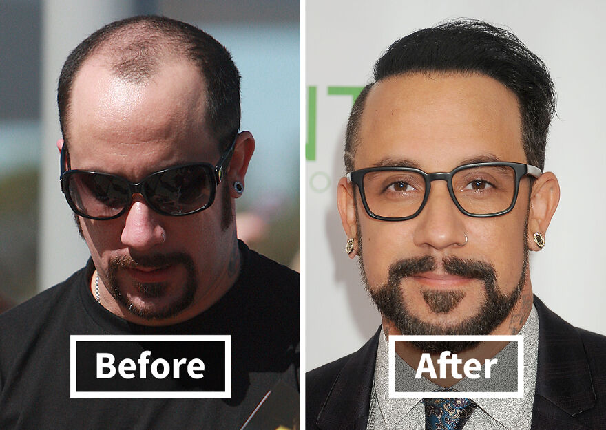 Before and after images of a A.J. Mclean  showcasing dramatic hair transplant results with fuller and styled hair.