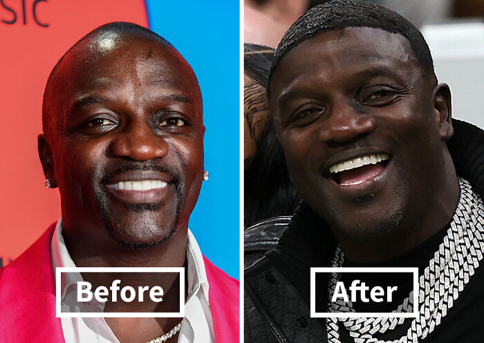 Before and after photos of a celebrity showing noticeable improvement after hair transplants with a fuller hairline and smile.