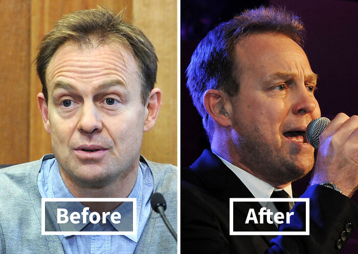 Side-by-side before and after photos showing celebrity hair transplant results with improved hair density and appearance.