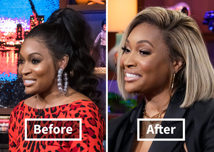 Side-by-side photos of a woman before and after hair transplant showing noticeable hair restoration results.
