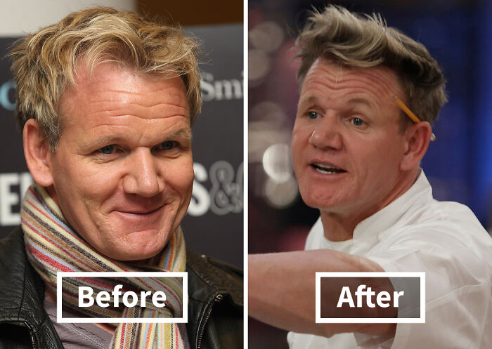 Side-by-side comparison of a celebrity before and after hair transplants showing noticeable hair improvement.